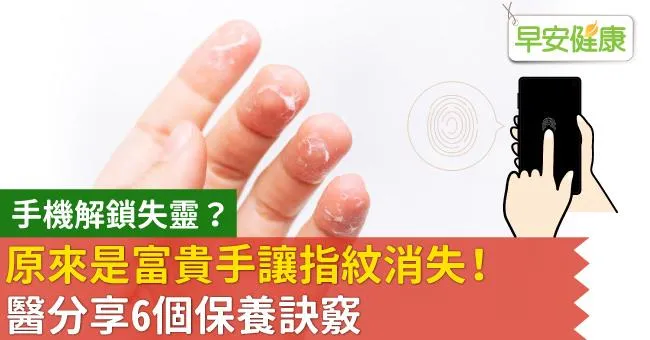 手機解鎖失靈？原來是富貴手讓指紋消失！醫分享6個保養訣竅