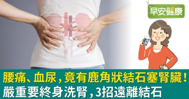 腰痛、血尿，竟有鹿角狀結石塞腎臟！嚴重要終身洗腎，3招遠離結石