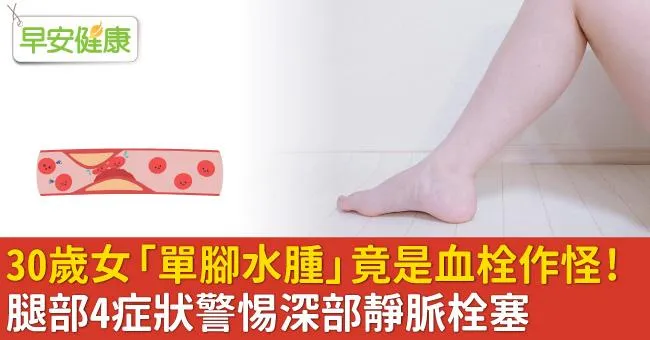 30歲女「單腳水腫」竟是血栓作怪！腿部4症狀警惕深部靜脈栓塞