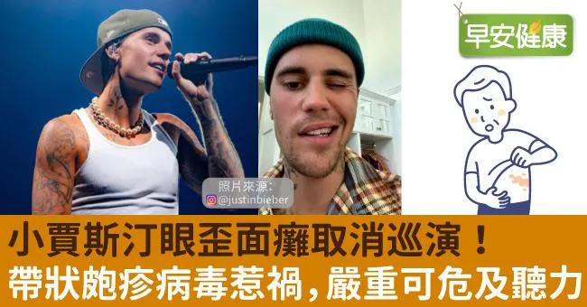 小賈斯汀眼歪面癱取消巡演！帶狀皰疹病毒惹禍，嚴重可危及聽力