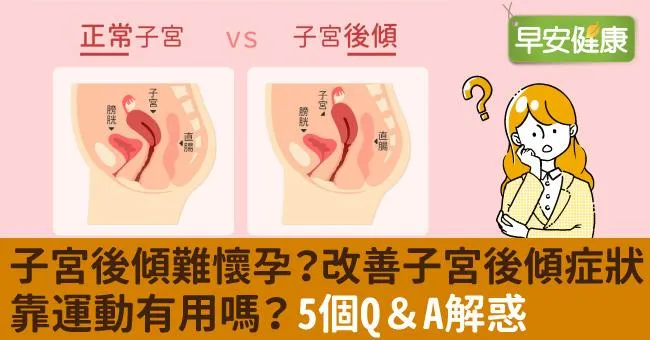 子宮後傾難懷孕？改善子宮後傾症狀靠運動有用嗎？5個Q＆A解惑