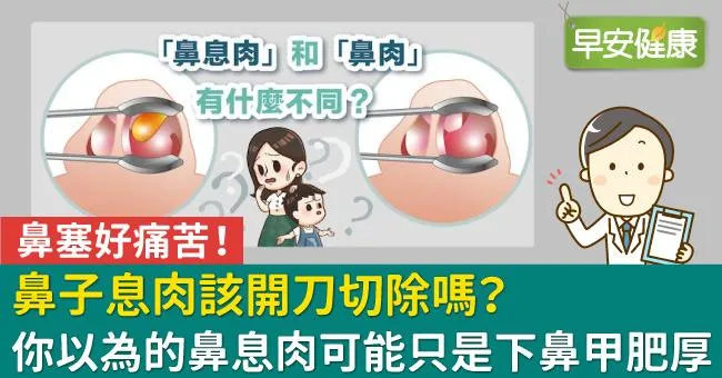 鼻息肉該開刀切除嗎？你以為的鼻息肉可能只是下鼻甲肥厚
