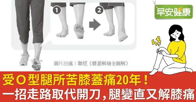 受O型腿所苦膝蓋痛20年！一招走路取代開刀，腿變直又解膝痛