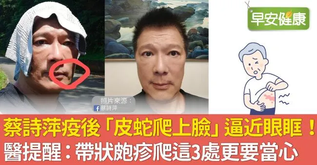蔡詩萍疫後「皮蛇爬上臉」逼近眼眶！醫師提醒：帶狀皰疹爬這3處更要當心