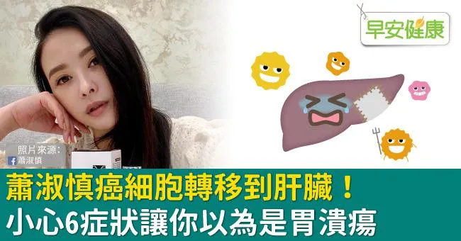 蕭淑慎癌細胞轉移到肝臟！小心6症狀讓你以為是胃潰瘍