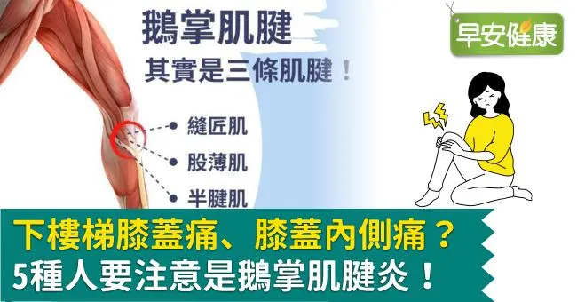 下樓梯膝蓋痛、膝蓋內側痛？5種人要注意是鵝掌肌腱炎！