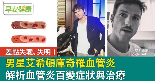 男星艾希頓庫奇罹血管炎差點失聰、失明！解析血管炎百變症狀與治療