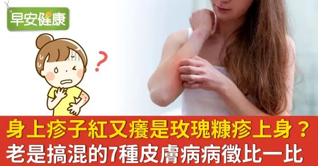 身上疹子紅又癢是玫瑰糠疹上身？老是搞混的7種皮膚病病徵比一比