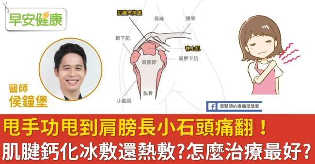 甩手功甩到肩膀長小石頭痛翻！肌腱鈣化冰敷還熱敷？怎麼治療最好？