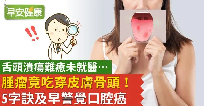 舌頭潰瘍難癒未就醫…腫瘤竟吃穿皮膚骨頭！5字訣及早警覺口腔癌