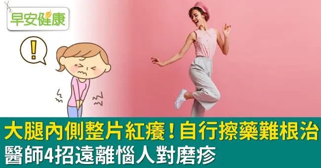 大腿內側整片紅癢！自行擦藥難根治，醫師4招遠離惱人對磨疹