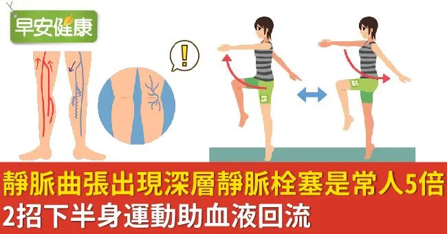 靜脈曲張出現深層靜脈栓塞是常人5倍！2招下半身運動助血液回流