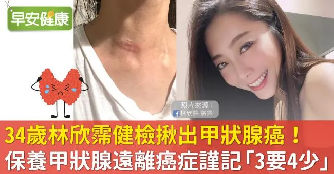 34歲林欣霈健檢揪出甲狀腺癌！保養甲狀腺遠離癌症謹記「3要4少」