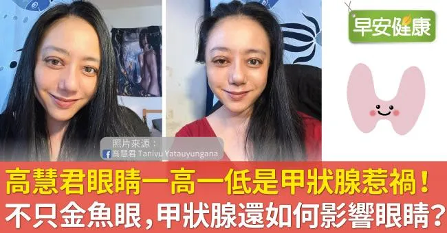 高慧君「眼睛一高一低」像驚悚片！不只金魚眼，甲狀腺還如何影響眼睛？