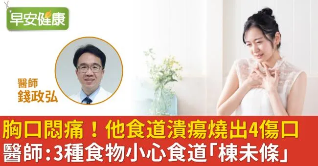 胸口悶痛！他食道潰瘍燒出4傷口！醫師：3種食物小心食道「棟未條」