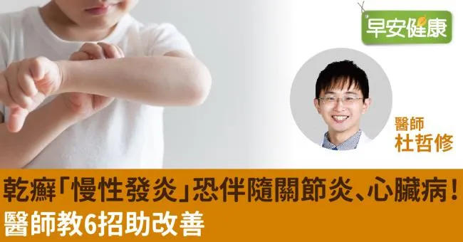 乾癬「慢性發炎」恐伴隨關節炎、心臟病！醫師教6招助改善