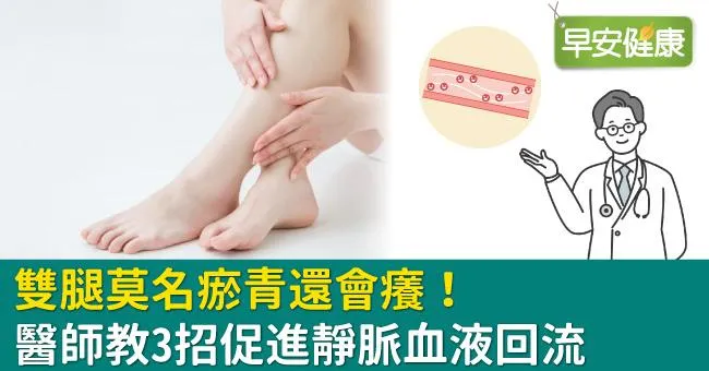 雙腿莫名瘀青還會癢！醫師教3招促進靜脈血液回流