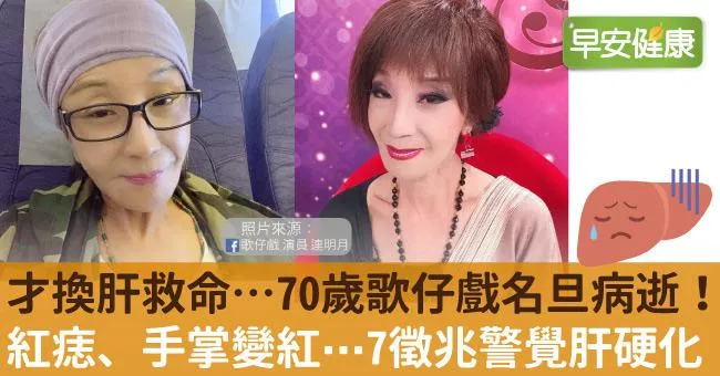 才剛換肝救命⋯70歲歌仔戲名旦病逝！紅痣、手掌變紅⋯7徵兆警覺肝硬化