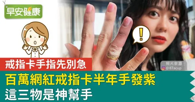 戒指卡手指先別急！百萬網紅戒指卡半年手發紫，這三物是神幫手
