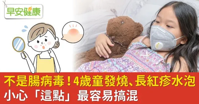 不是腸病毒！4歲童發燒、長紅疹水泡，小心「這點」最容易搞混