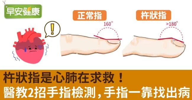 杵狀指是心肺在求救！醫教2招手指檢測，手指一靠找出病