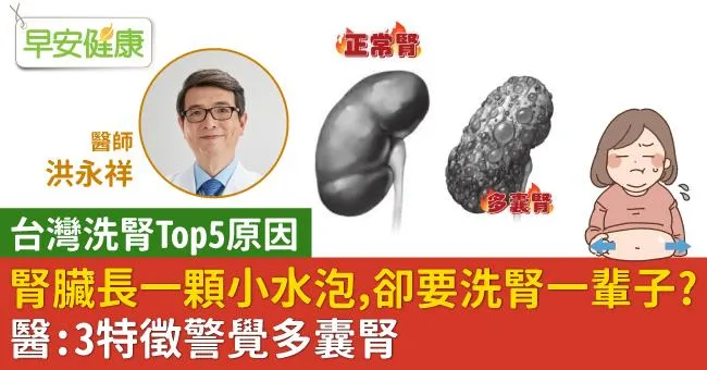 腎臟長一顆小水泡，卻要洗腎一輩子？醫：3特徵警覺多囊腎