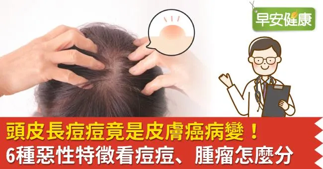 頭皮長痘痘竟是皮膚癌病變！6種惡性特徵看痘痘、腫瘤怎麼分