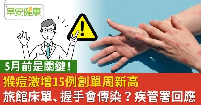 猴痘激增15例創單周新高，5月前是關鍵！旅館床單、握手會傳染？疾管署回應