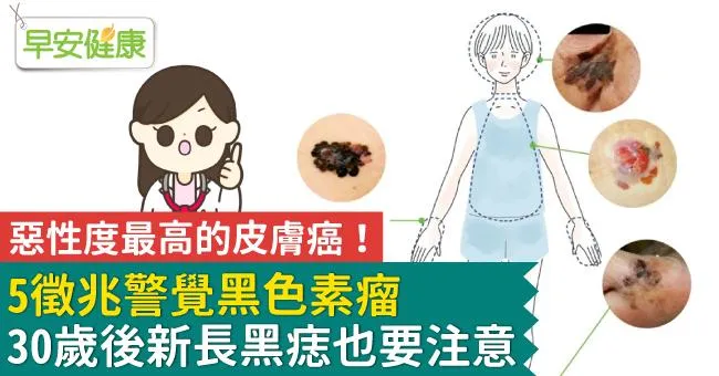 惡性度最高的皮膚癌！5徵兆警覺黑色素瘤，30歲後新長黑痣也要注意