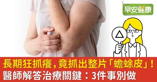 長期狂抓癢，竟抓出整片「蟾蜍皮」！醫師解答治療關鍵：3件事別做