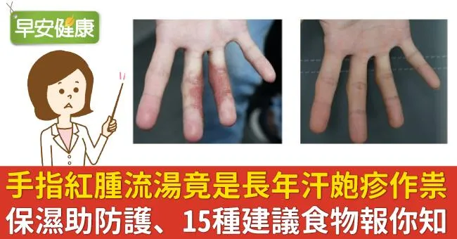 手指嚴重紅腫流湯，竟是長年汗皰疹作祟！保濕助防護、15種建議食物報你知