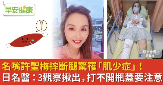 名嘴許聖梅摔斷腿驚罹「肌少症」！日名醫：3觀察揪出，打不開瓶蓋要注意
