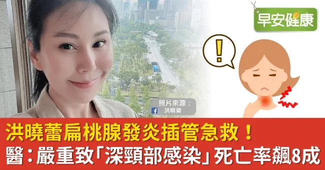 洪曉蕾扁桃腺發炎插管急救！醫：嚴重致「深頸部感染」死亡率飆8成