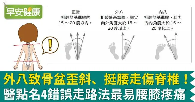 外八致骨盆歪斜、挺腰走傷脊椎！醫點名4錯誤走路法最易腰膝疼痛