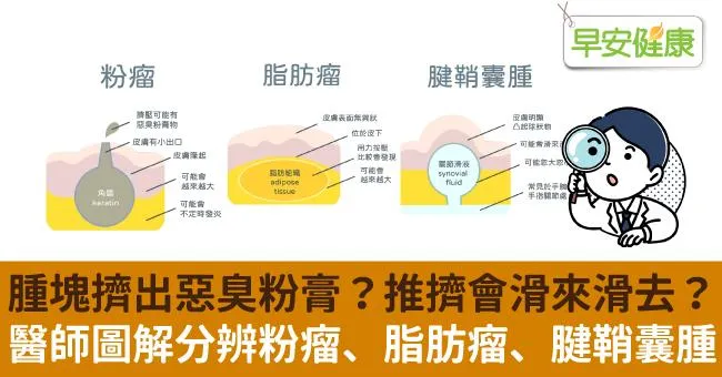 腫塊擠出惡臭粉膏？推擠會滑來滑去？醫師圖解分辨粉瘤、脂肪瘤、腱鞘囊腫