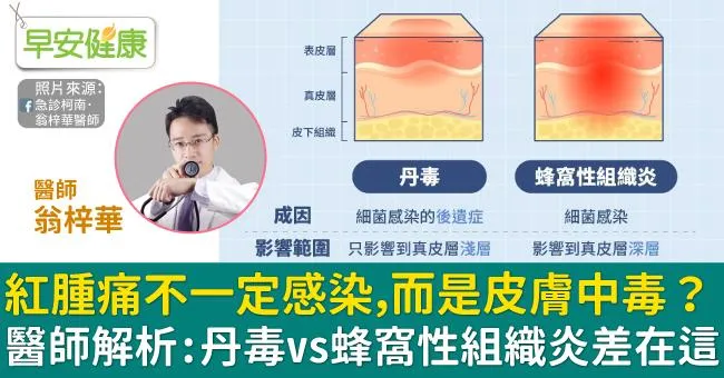 紅腫痛不一定感染，而是皮膚中毒？醫師解析：丹毒vs蜂窩性組織炎差在這
