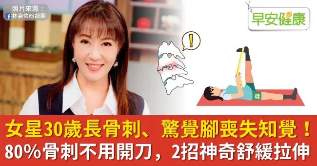 女星30歲長骨刺、驚覺腳喪失知覺！80％骨刺不用開刀，2招神奇舒緩拉伸