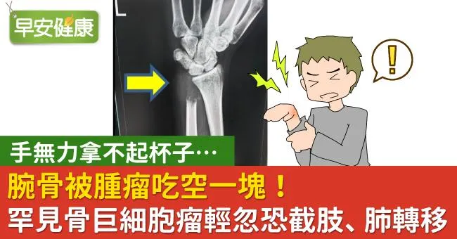 手無力拿不起杯子…腕骨被腫瘤吃空一塊！罕見骨巨細胞瘤輕忽恐截肢、肺轉移