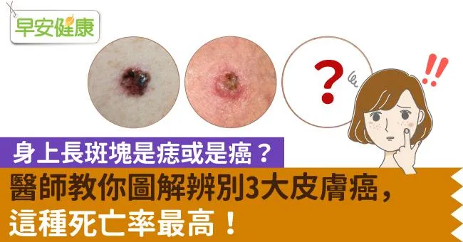 身上長斑塊是痣或是癌？醫師教你圖解辨別3大皮膚癌，這種死亡率最高！