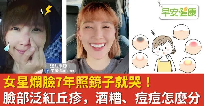 女星爛臉7年照鏡子就哭！臉部泛紅丘疹，酒糟、痘痘怎麼分？