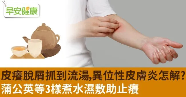 皮癢脫屑抓到流湯，異位性皮膚炎怎解？蒲公英等3樣煮水濕敷助止癢