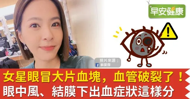 女星眼冒大片血塊，血管破裂了！眼中風、結膜下出血症狀這樣分