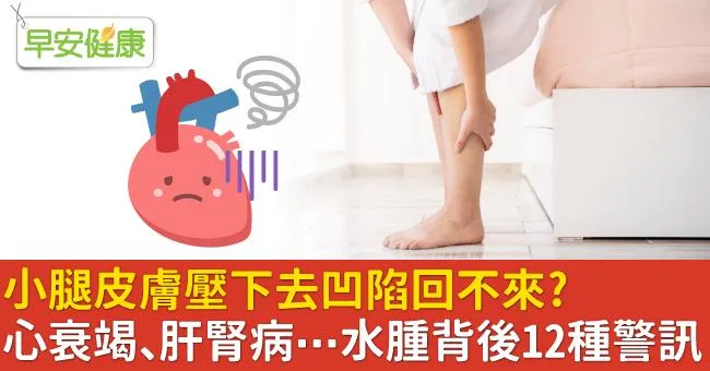 小腿皮膚壓下去凹陷回不來？心衰竭、肝腎病…水腫背後的12病症警訊