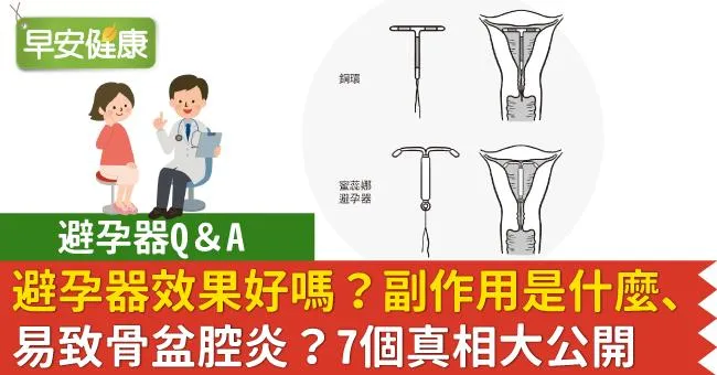 避孕器效果好嗎？副作用是什麼、易致骨盆腔炎？7個真相大公開