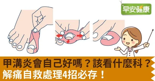 甲溝炎會自己好？擦藥膏能消腫？該看什麼科醫生？甲溝炎自救處理4招必存