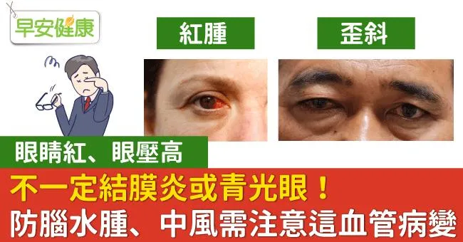眼睛紅、眼壓高，不一定結膜炎或青光眼！防腦水腫、中風需注意這血管病變