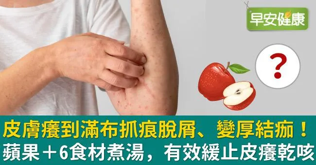 皮膚癢到滿布抓痕脫屑、變厚結痂！蘋果＋6食材煮湯，有效緩止皮癢乾咳