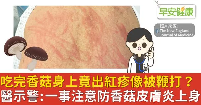 香菇吃完，身上竟出紅疹像被鞭打？醫示警：一事注意防香菇皮膚炎上身