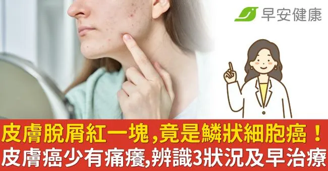 皮膚脫屑紅一塊，竟是鱗狀細胞癌！皮膚癌少有痛癢，辨識3狀況及早治療
