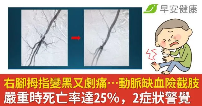 右腳拇指變黑又劇痛…動脈缺血險截肢！嚴重時死亡率達25％，2症狀警覺